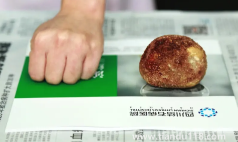 腎結(jié)石3mm需要吃藥嗎（3mm的腎結(jié)石會(huì)尿血嗎）