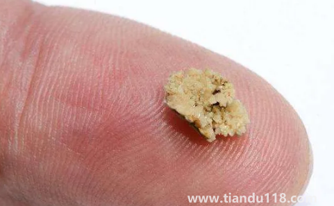 腎結石三毫米可以碎嗎(三毫米的腎結石算大的嗎)(圖2) 腎結石三毫米可以碎嗎2