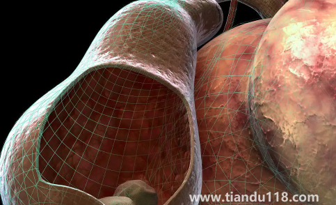 腎結石三毫米可以碎嗎(三毫米的腎結石算大的嗎)(圖3) 腎結石三毫米可以碎嗎3