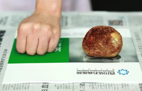 腎結(jié)石3mm需要治療嗎(腎結(jié)石3mm是多久形成的)(圖3) 腎結(jié)石3mm需要治療嗎3