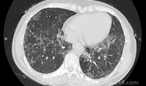 如何自查是否出現(xiàn)白肺（肺白了還能恢復嗎）